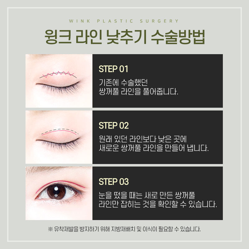 Are All Revision Eyelid Surgeries the Same? For High Crease "Sausage Eyes," Use Two-Line Technique to Lower the Front Line image 3