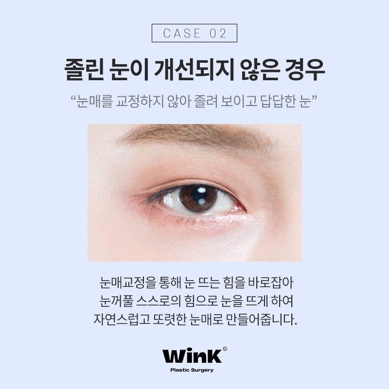 Types of Double Eyelid Revision Surgery and Solutions at Wink Plastic Surgery, Sinsa Station image 4