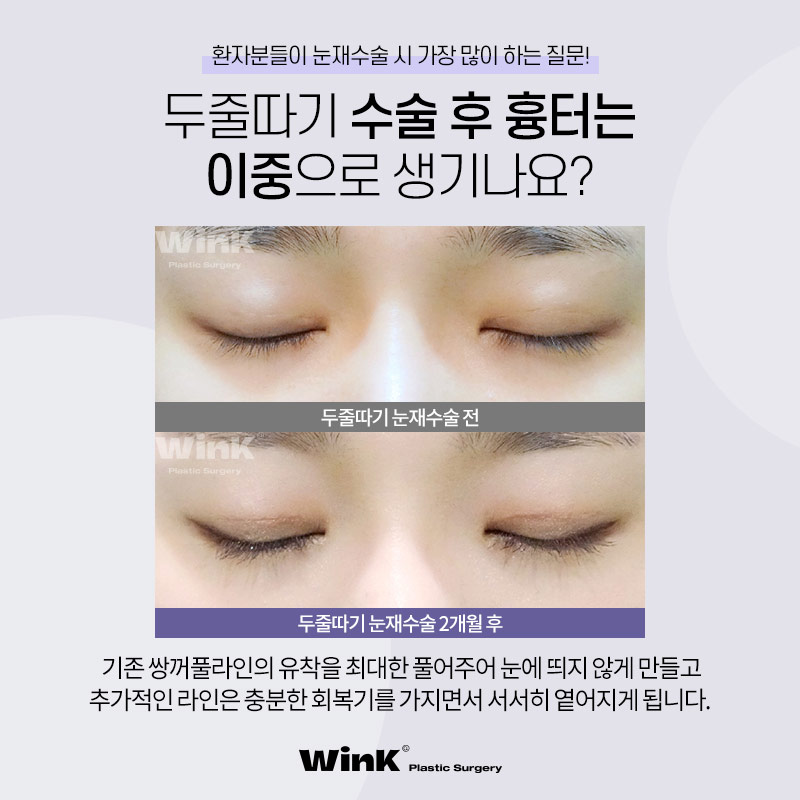 두껍고 높은 소세지눈? 윙크성형외과 두줄따기로 라인낮추기! 관련 이미지 5