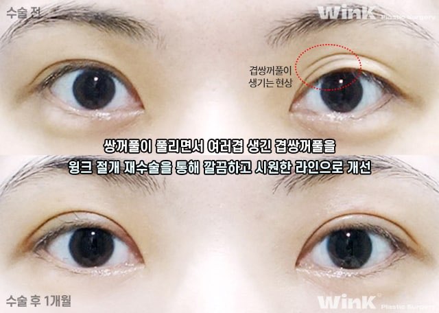 겹쌍꺼풀 해결 방법에 대해 알아보겠습니다. 관련 이미지 4