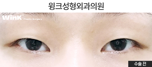 Let’s Learn About Before and After Natural Adhesion Double Eyelid Surgery image 5