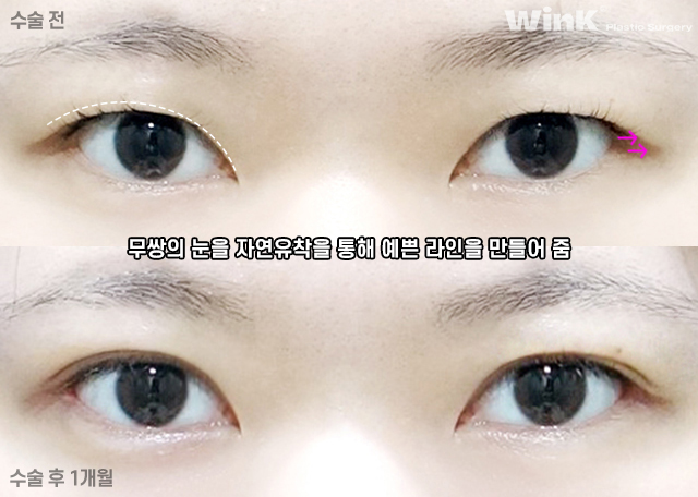What Are the Important Factors for Successful Revision Eye Surgery? image 4