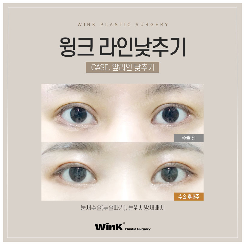 신사두줄따기 윙크성형외과 쌍꺼풀풀기 쌍꺼풀라인낮추기 소세지쌍꺼풀재수술 관련 이미지 7