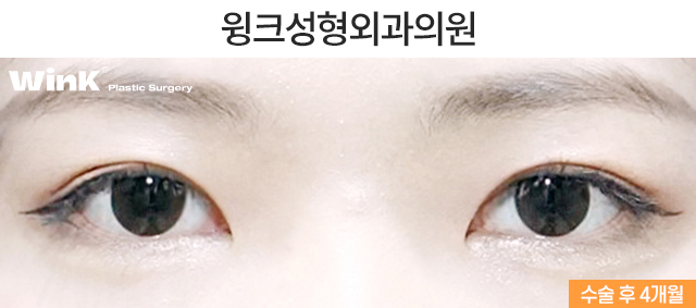 통통한 쌍꺼풀과 겹주름, 해결 방법은? 관련 이미지 3