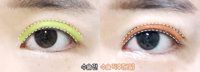 높고 깊은 고정으로 생긴 소세지눈, 윙크성형외과 두줄따기로 라인낮추기! 관련 이미지 8