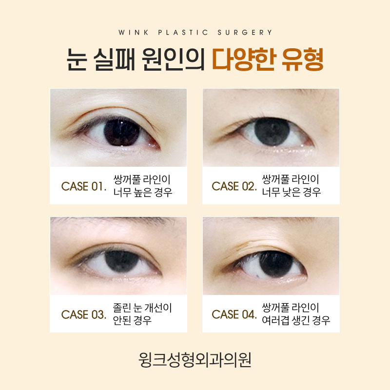 절개쌍꺼풀 재수술 시 알아야 둬야 할 것은 무엇일까요? 관련 이미지 3