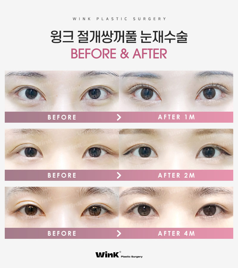 기능성과 심미성 모두 고려한 윙크성형외과 절개쌍꺼풀재수술! 관련 이미지 6