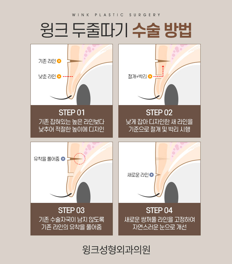 두줄따기로 라인 낮추기 하고 나서 흉터는 어떨까? 관련 이미지 4