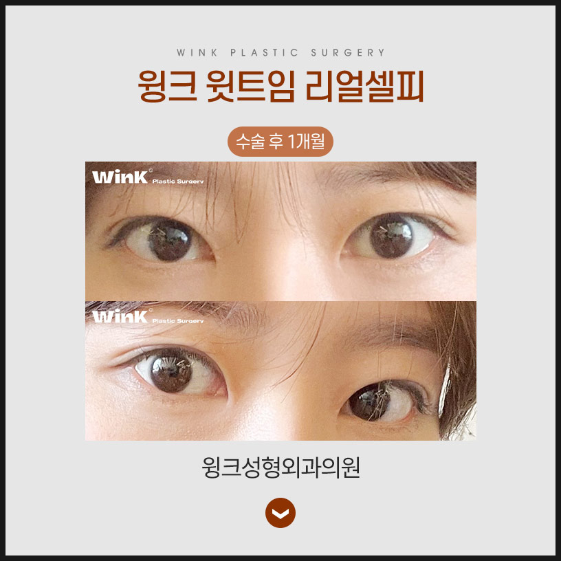 트임성형 윗트임으로 전체적으로 눈을 시원하게! 관련 이미지 7
