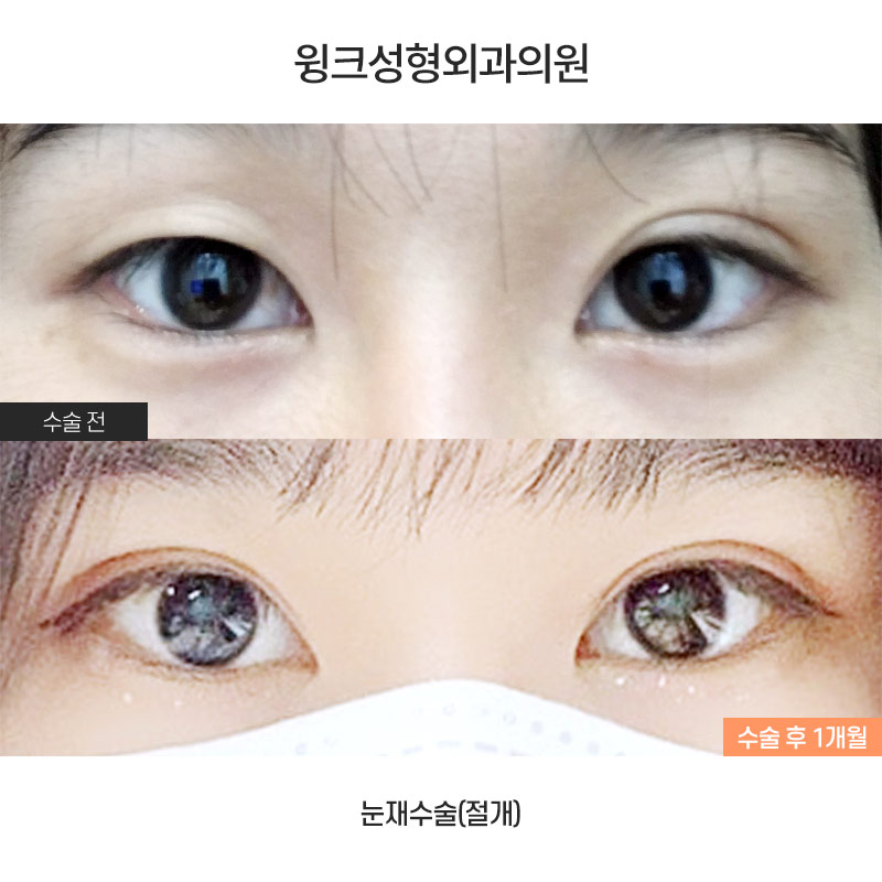 Is It Okay to Have Double Eyelid Surgery on Only One Side? image 1