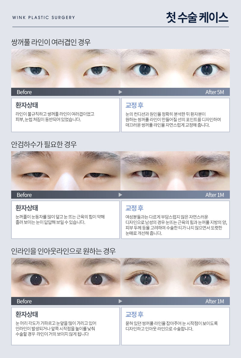 오직 눈 성형만 연구한 눈수술, 눈재수술 명의 윙크성형외과 최승협 대표원장님 관련 이미지 7