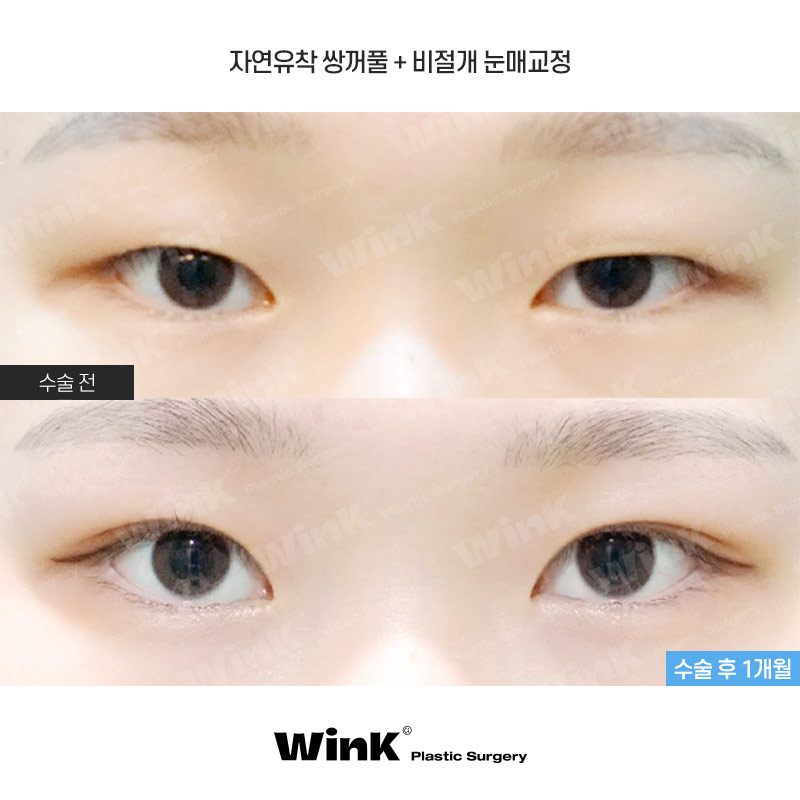 The Key to Ptosis Correction Is Proper Iris Exposure! image 1