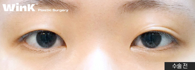 Is Fast Recovery Only Possible with Non-Incisional Surgery? At Wink Plastic Surgery, Incisional Double Eyelid Surgery Can Also Return You to Daily Life Quickly! image 5