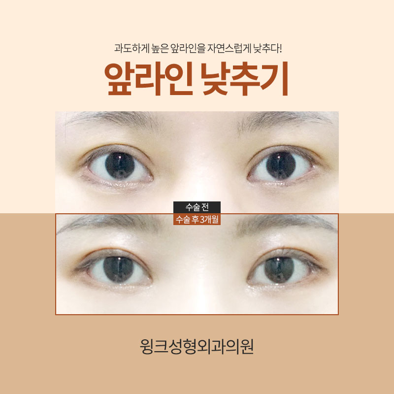 앞쪽이 두꺼운 아웃라인 쌍꺼풀, 해결 방법은? 관련 이미지 3