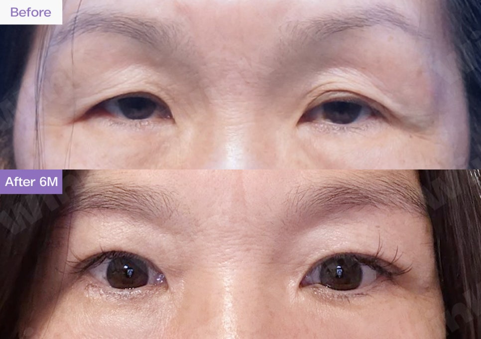 Upper Blepharoplasty or Sub-Brow Lift? Which Procedure Is Suitable for Middle-Aged Eye Plastic Surgery? image 3