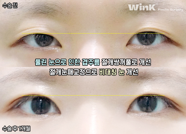 높은 쌍꺼풀 라인, 겹쌍꺼풀과 같은 유형의 눈재수술 방법은? 관련 이미지 7