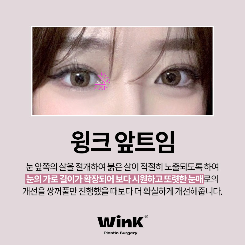 윙크 앞트임, 답답한 눈 앞머리를 시원하게 관련 이미지 2
