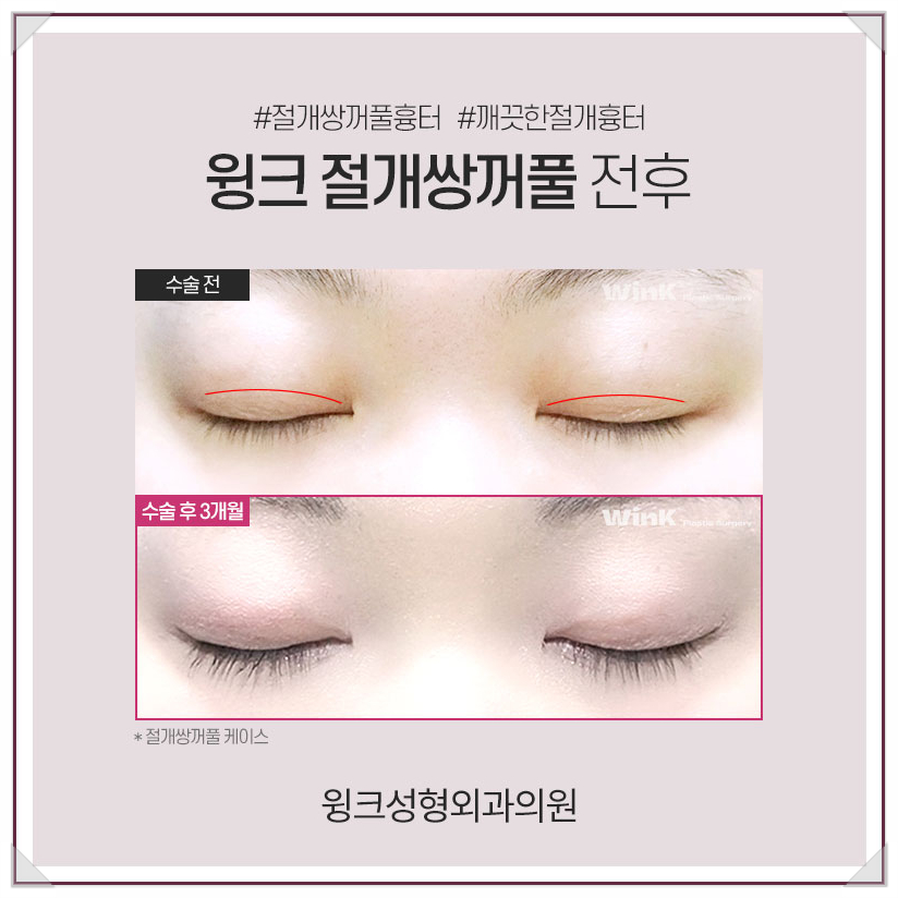 Incisional Double Eyelid Surgery: A Natural Line Without Worrying About Scars Even After Surgery! image 6