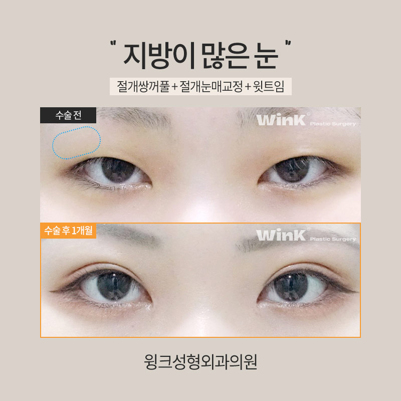 How Is Double Eyelid Surgery Performed on Eyes with a Lot of Fat? image 5