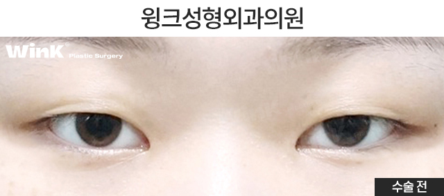 절개 쌍꺼풀 수술법에 관해 알아보겠습니다. 관련 이미지 2