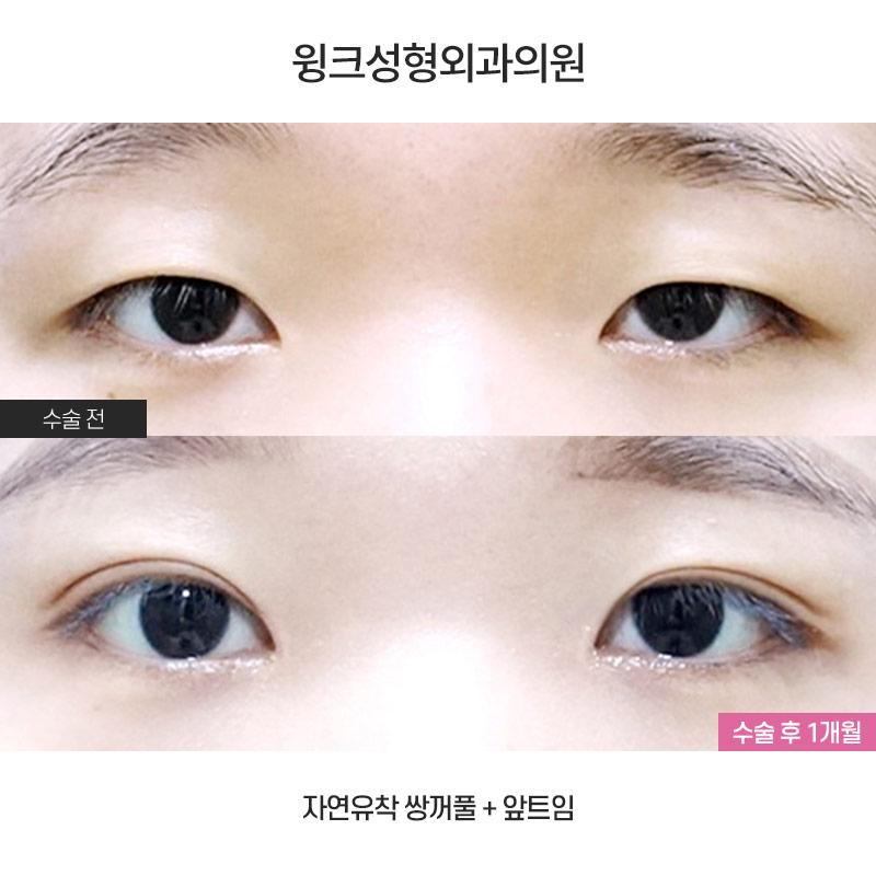 Should We Leave Eyelid Tape and Eyelid Glue Behind with Natural Adhesion Double Eyelid Surgery? image 1