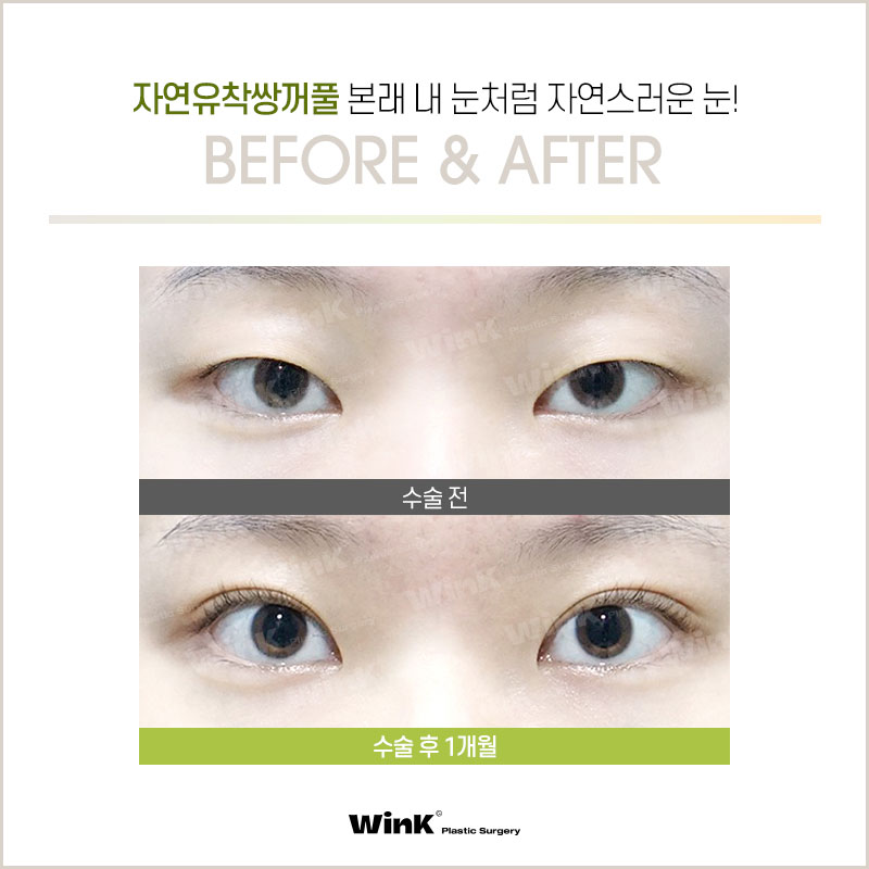 What Are the Differences Between Natural Adhesion and Buried Double Eyelid Surgery? Everything You Need to Know About Natural Adhesion, as Told by Wink Plastic Surgery! image 7