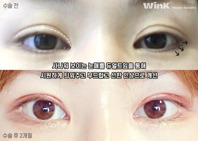 듀얼트임으로 자연스럽게 눈을 키우는 방법에 대해 알아볼까요? 관련 이미지 7