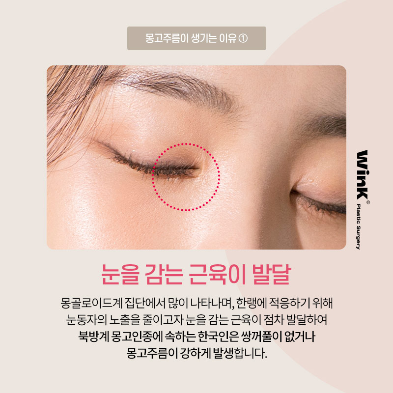 The Impact of Epicanthal Folds on Double Eyelid Surgery! Epicanthoplasty, Epicanthoplasty Cost, Sinsa Epicanthoplasty image 3