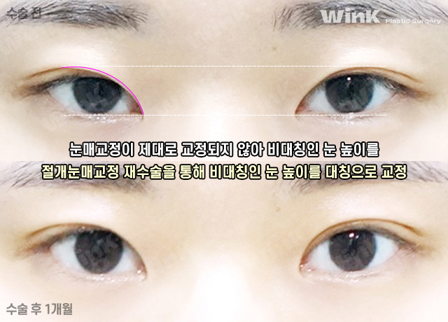 눈동자 노출량을 키워주어 또렷한 눈매로 만들어주는 윙크성형외과 눈매교정! 관련 이미지 10