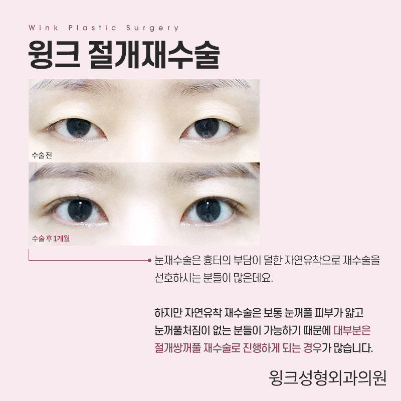 절개 쌍꺼풀 흉터에 대해 알아보겠습니다. 관련 이미지 2