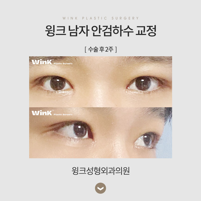 남자 안검하수 교정에 관해 알아보겠습니다. 관련 이미지 5