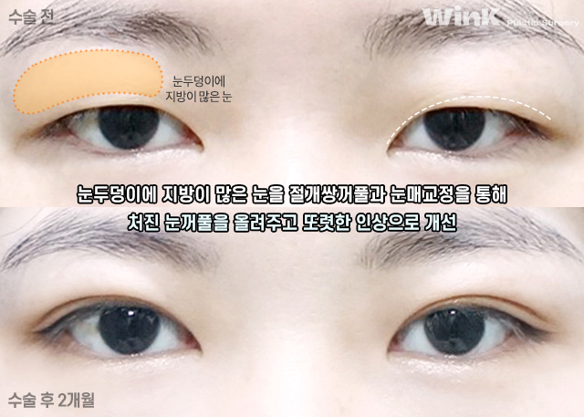 Let’s Learn About Incisional Double Eyelid Surgery. image 4