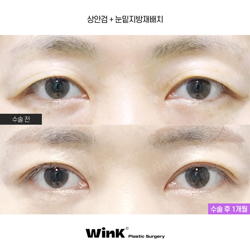 Improve Droopy Eyes with Wink Middle-Age Eyelid Surgery! image 1