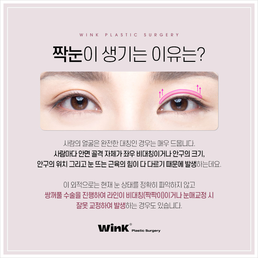 눈짝짝이 짝짝이눈 고민이라면 윙크성형외과 짝눈수술 짝눈교정전후 관련 이미지 2