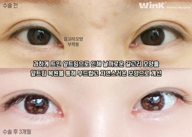 Can Medial Epicanthoplasty Revision and Incisional Double Eyelid Revision Be Done at the Same Time? image 4
