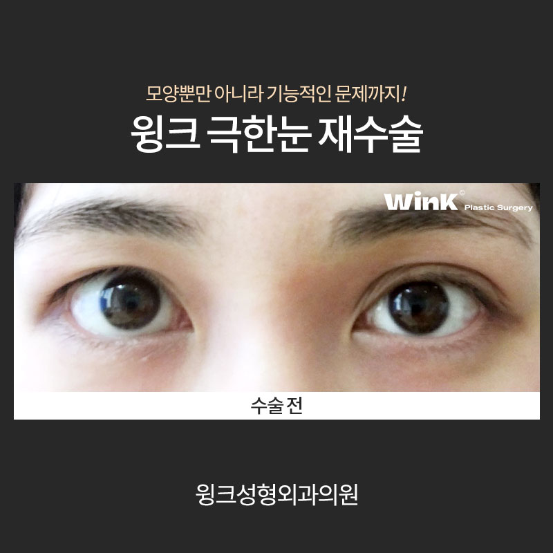 Let’s Learn About Revision Surgery for Severe Eyes? image 6