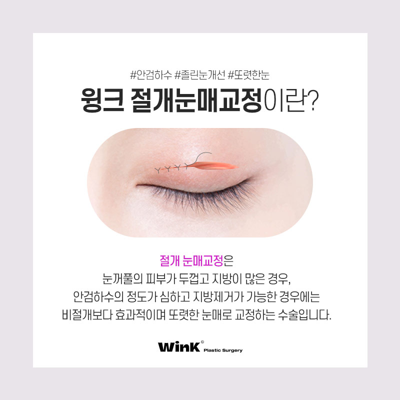 눈동자 노출량을 키워주어 또렷한 눈매로 만들어주는 윙크성형외과 눈매교정! 관련 이미지 7