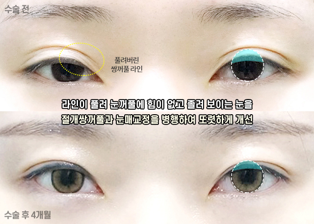 Case Examples of Correcting Uneven Eyes Through Ptosis Correction image 6