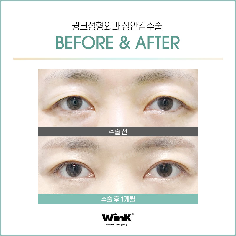 윙크성형외과에서 알려드리는 상안검에 대한 모든 것! 관련 이미지 9