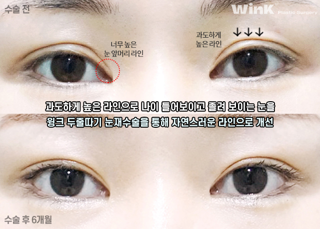 Let’s Learn About Double-Eyelid Revision Surgery with an Incision for a Thick Front Line image 8
