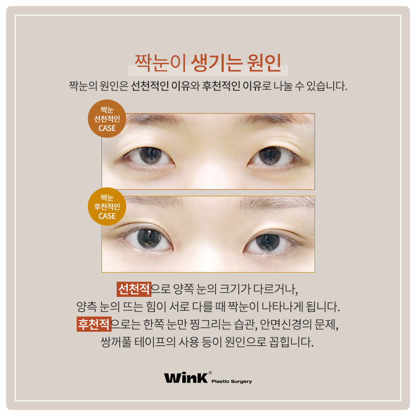 짝눈눈매교정술 잘하는곳? 비대칭짝눈교정 짝눈쌍수 잘하는 윙크성형외과 눈매교정짝눈! 관련 이미지 3