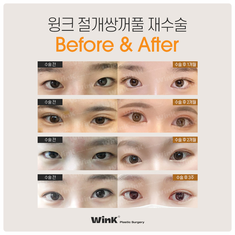 쌍꺼풀절개재수술 신사쌍꺼풀수술 쌍꺼풀수술잘하는곳? 윙크성형외과 관련 이미지 8
