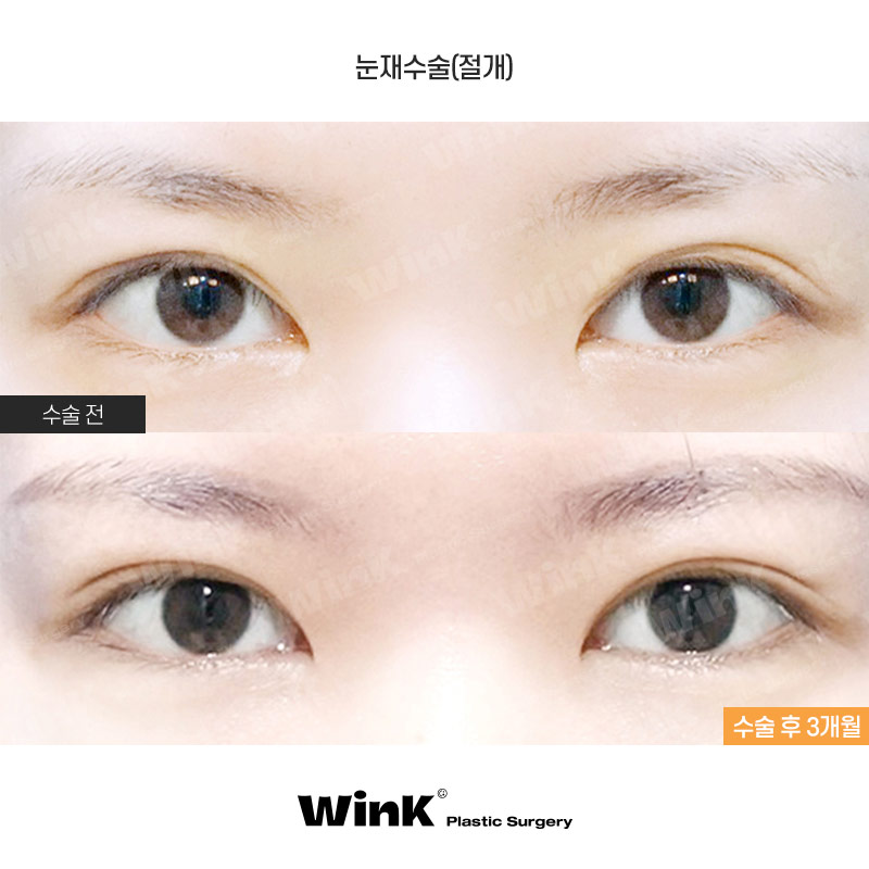 Wink’s Upper Blepharoplasty Revision Surgery, Considering Both Function and Aesthetics image 1