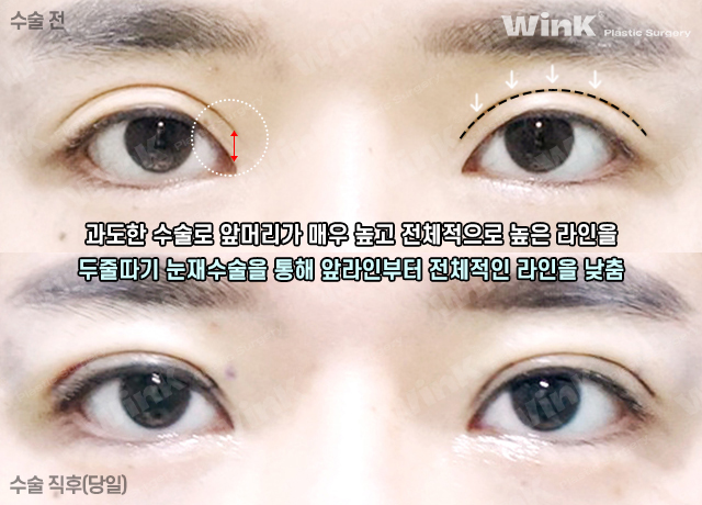 높고 깊은 고정으로 생긴 소세지눈, 윙크성형외과 두줄따기로 라인낮추기! 관련 이미지 9