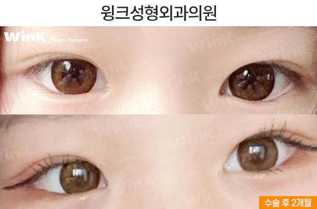 중학생 쌍커풀수술에 대해 알아볼까요? 관련 이미지 12