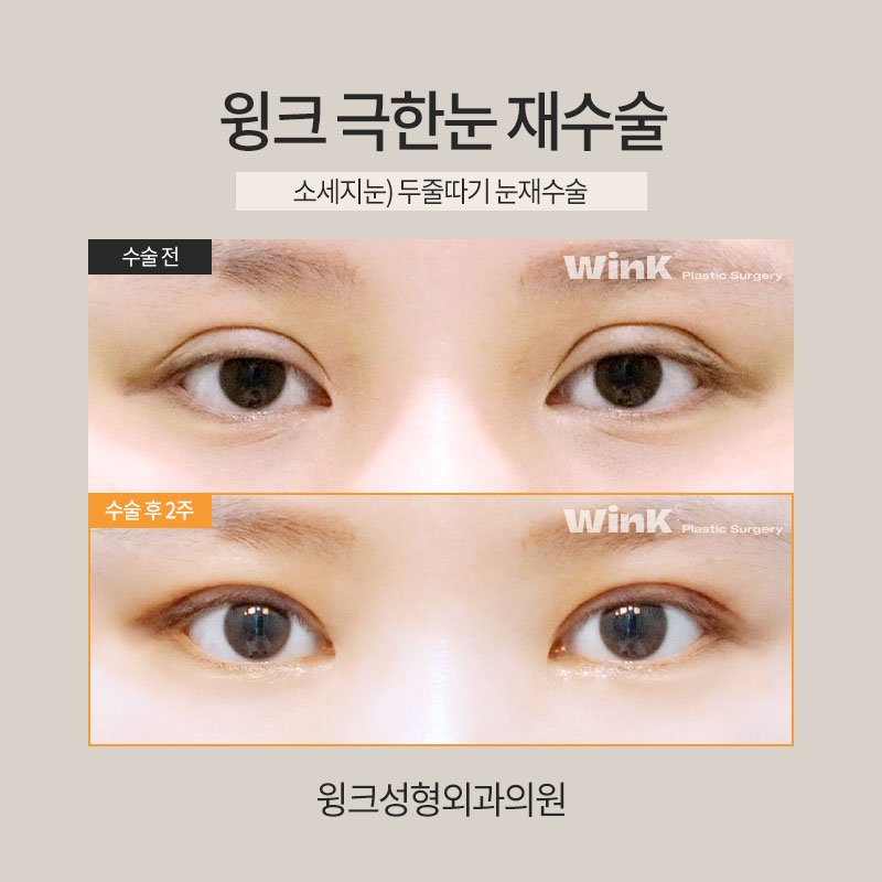 Let’s Learn About Revision Surgery for Severe Eyes? image 4