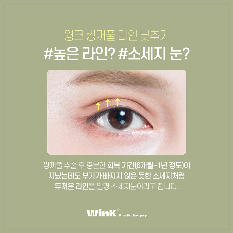 부담스러운 소세지눈? 윙크성형외과 두줄따기 쌍꺼풀 라인낮추기로 호감형 이미지로! 관련 이미지 2