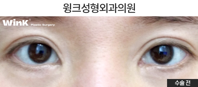 What Kind of Double Eyelids Suit Deep-Set Eyes? image 2