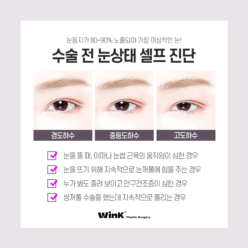 눈동자 노출량을 키워주어 또렷한 눈매로 만들어주는 윙크성형외과 눈매교정! 관련 이미지 2