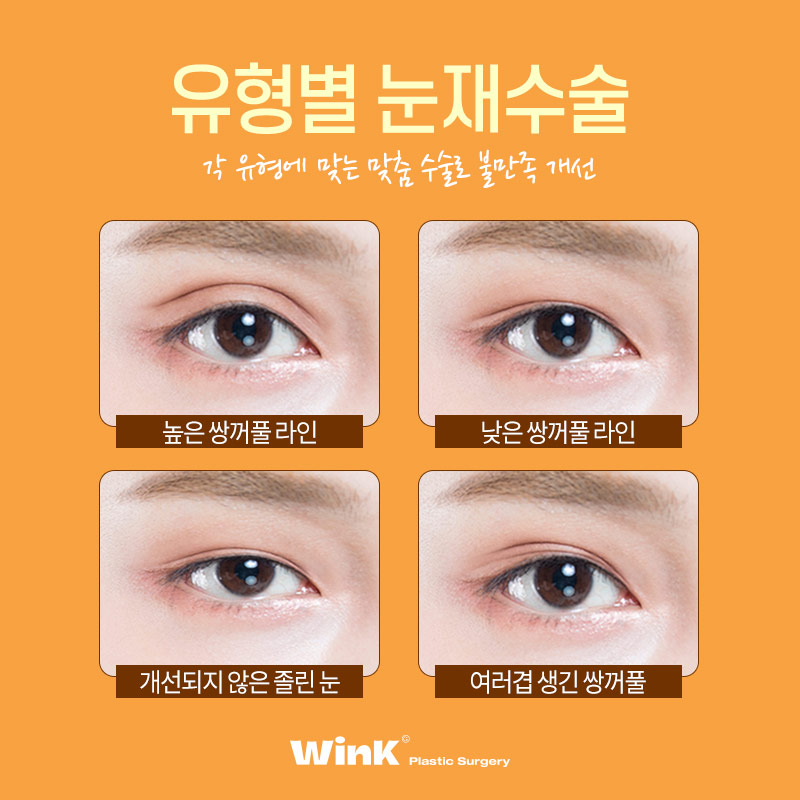 마지막 눈재수술을 위한 선택! 윙크성형외과 눈재수술 관련 이미지 3